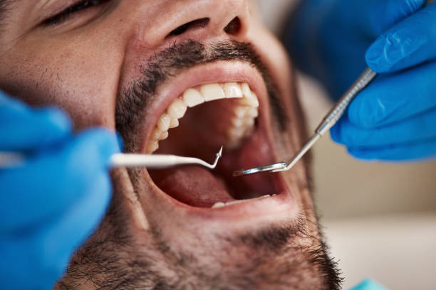 Best Emergency Tooth Extraction in Harbor Beach, MI